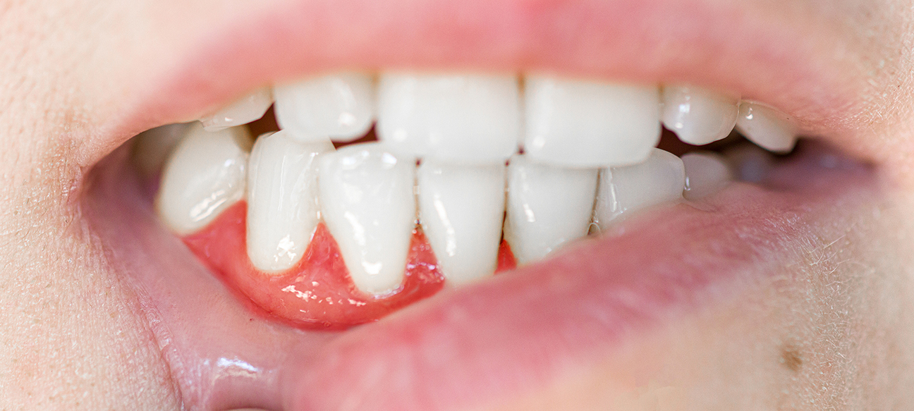 Common Causes & Treatments of Gingivitis